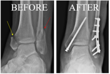 Broken ankle before and after surgery